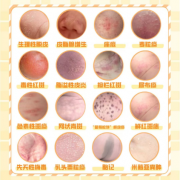 远离皮肤病，调节免疫系统